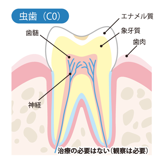 綾瀬亀有ロハス歯科＆矯正歯科で虫歯治療