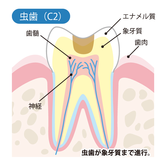 綾瀬亀有ロハス歯科＆矯正歯科で虫歯治療