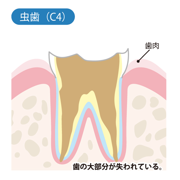 綾瀬亀有ロハス歯科＆矯正歯科で虫歯治療