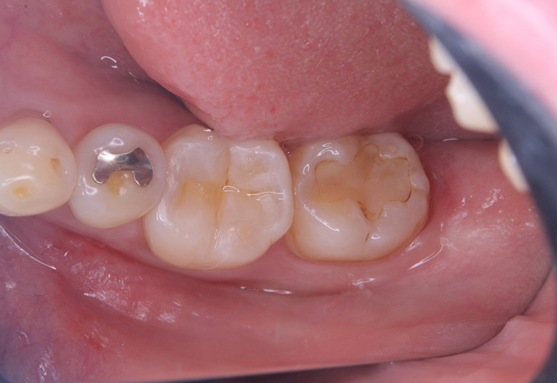 綾瀬亀有ロハス歯科＆矯正歯科の銀歯を白い歯に