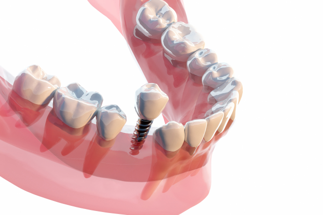 インプラント - 綾瀬・亀有のおすすめ歯医者｜綾瀬亀有ロハス歯科